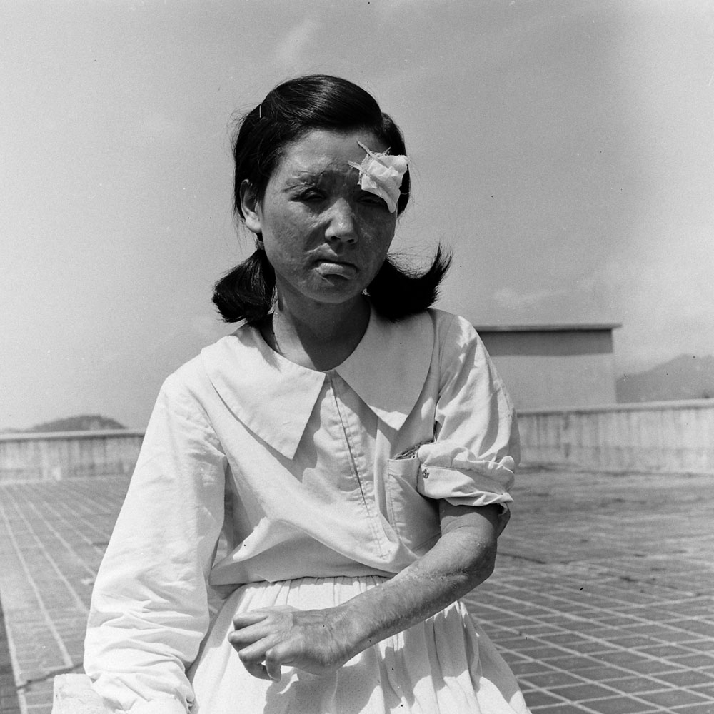 survivor of the bombing of Hiroshima, poses 2 years after the bombing, Hiroshima, Japan, 1947