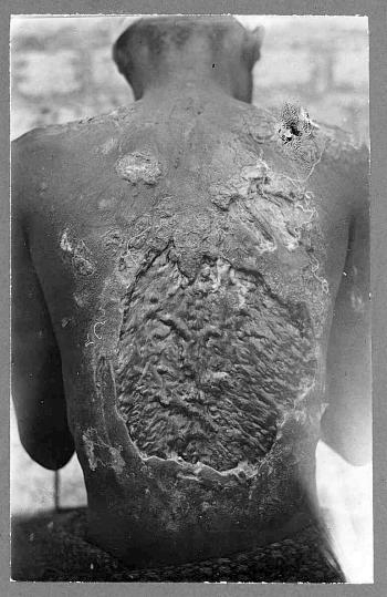 the back of a Namibian laborer covered in scar tissue from years of whipping by a German Farmer name…