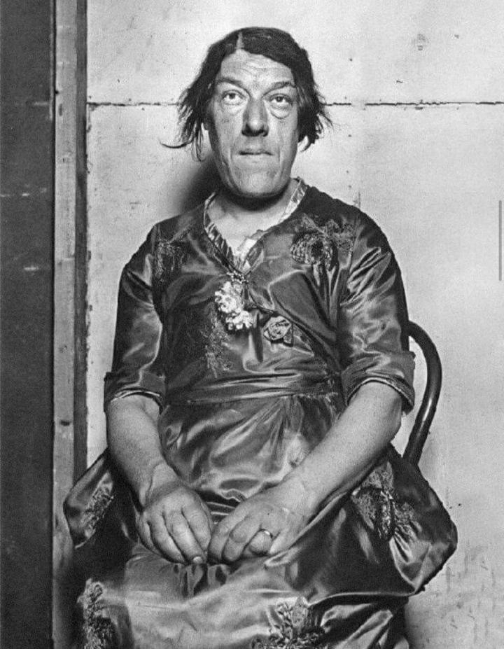 in 1920 in England, Mary Ann Bevan entered the “ Ugliest Woman in the World ” contest after developi…